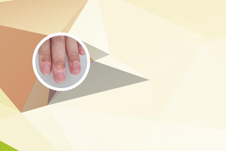 手指关节处白癜风康复案例