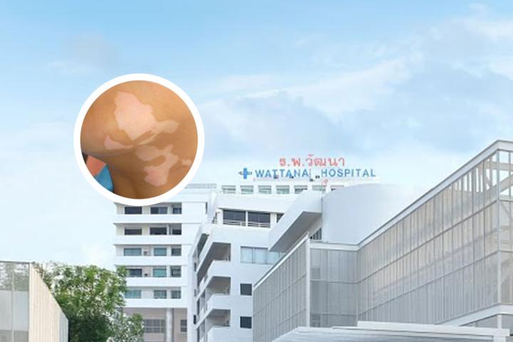 上海治疗白癜风华山医院
