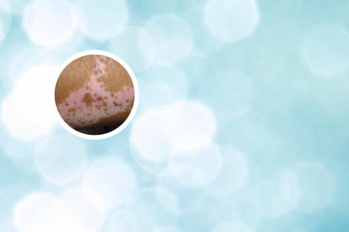 早期白斑病图片(白斑病早期图片
)