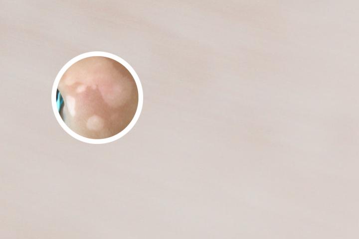 灰指甲白斑症状图片(白斑症状图片
)