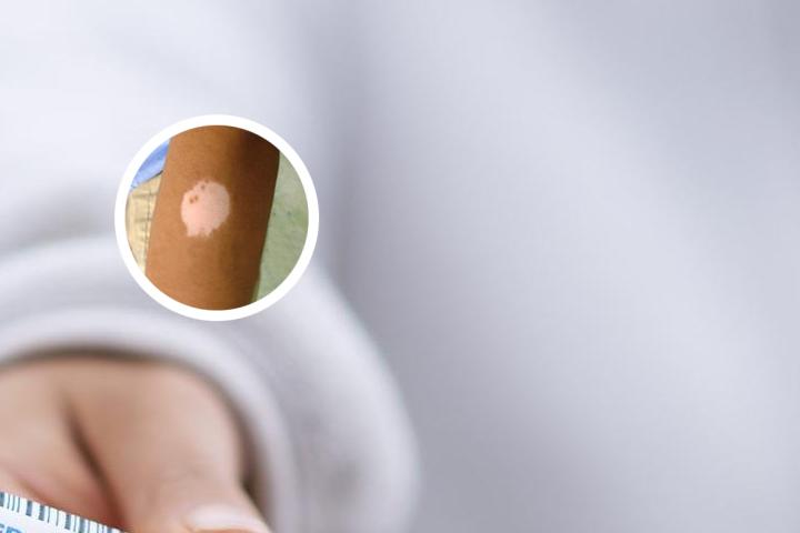 婴儿干疹发白(冬季干疹图片
)