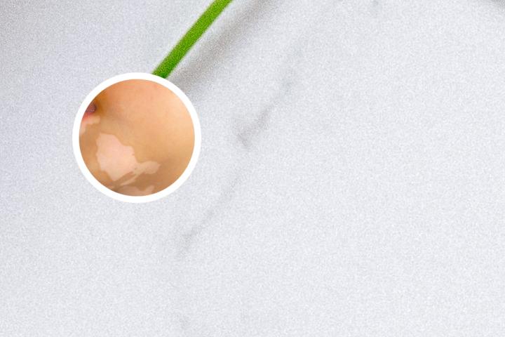 蕨麻白癜风能吃吗